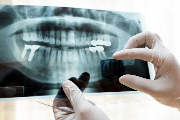 Radiología dental, rayos X dentadura - Clínica Dental Dentalhábilis