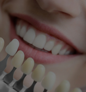 Blanqueamiento dental - Dentalhábilis
